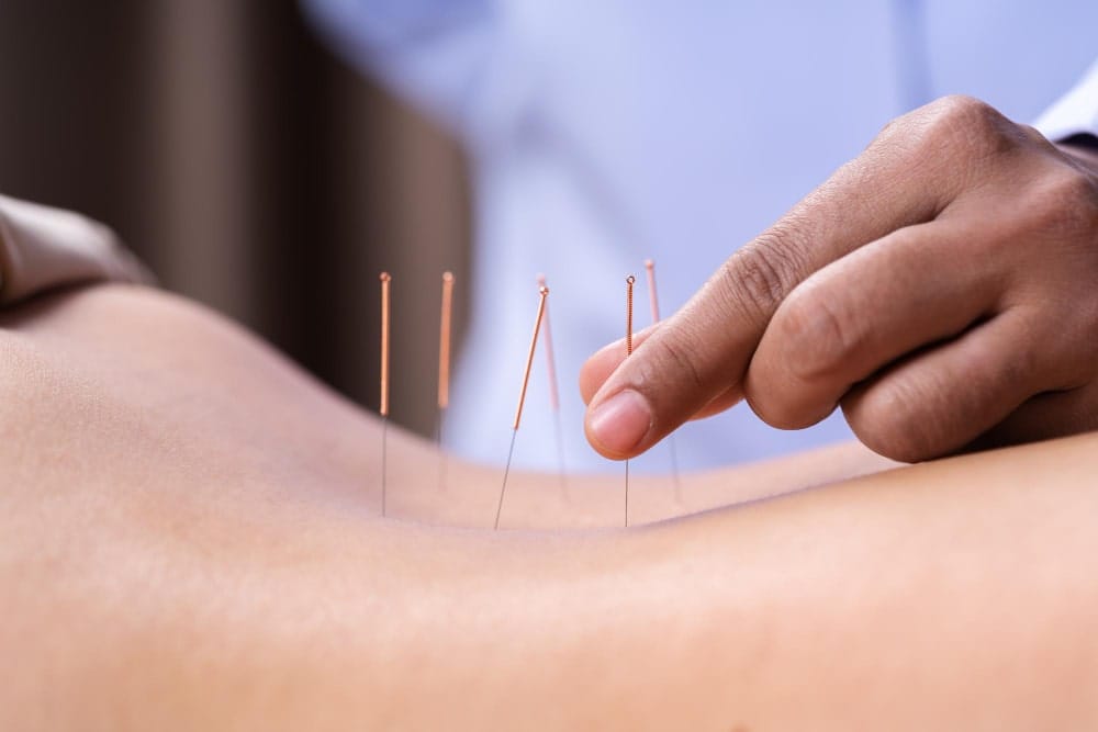 Acupuntura Tradicional Chinesa